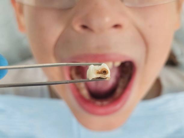 Best Urgent Tooth Repair  in Vevay, IN